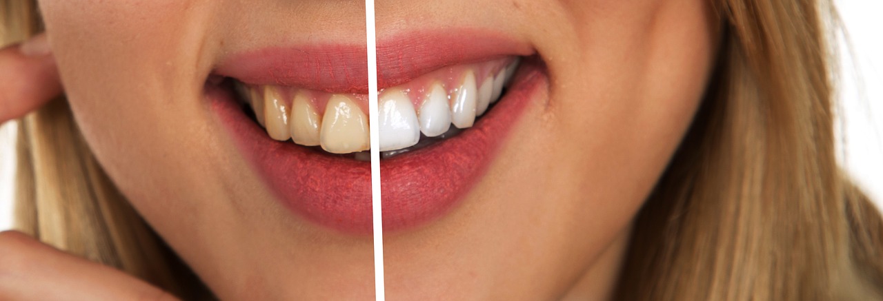 10 astuces pour avoir les dents plus blanches